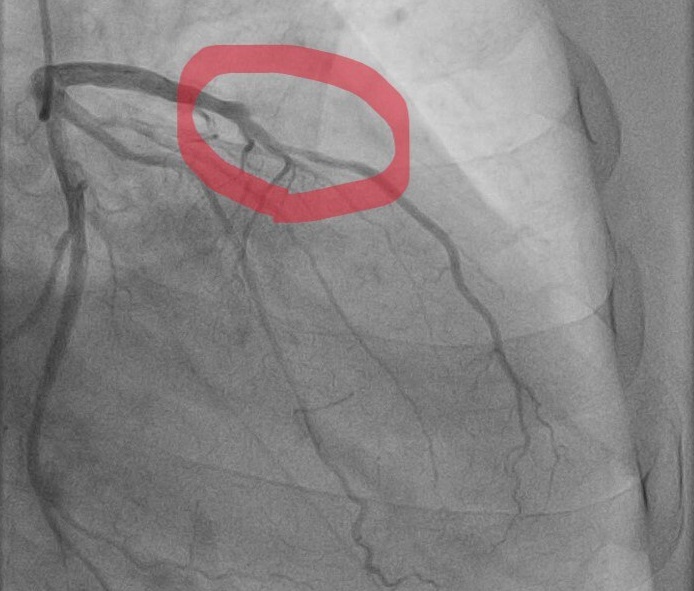Уборка снега едва не обернулась трагическими последствиями для саратовца